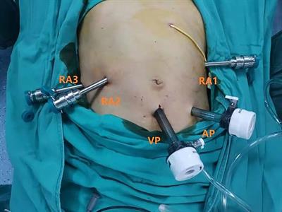 A comparative study of robotics and laparoscopic in minimally invasive pancreatoduodenectomy: A single-center experience